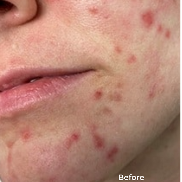 Close-up of a cheek and chin with red acne spots, labeled “Before” in the corner