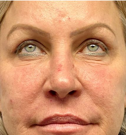 Close-up of a face with eyes looking upward, showing under-eye wrinkles and a small red mark on the nose