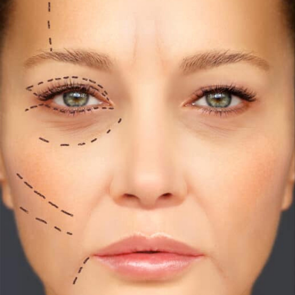 Close-up of a woman's face with dashed lines marking cosmetic surgery areas around the eyes, cheek, and chin