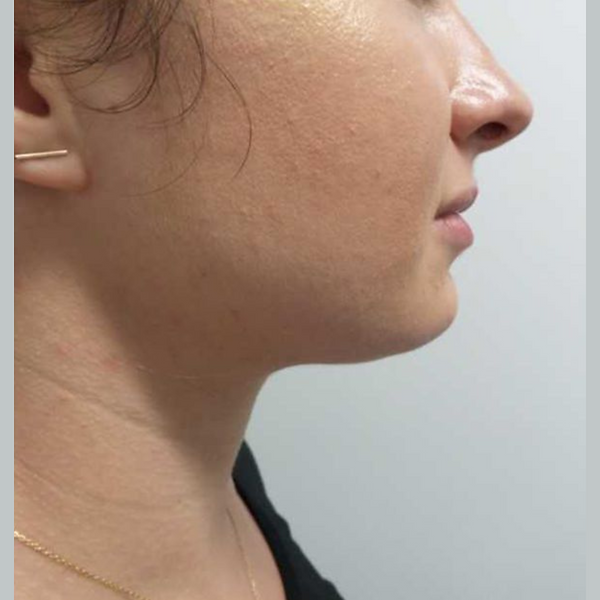 Side-profile of a person’s face and neck, showing the jawline against a plain background.