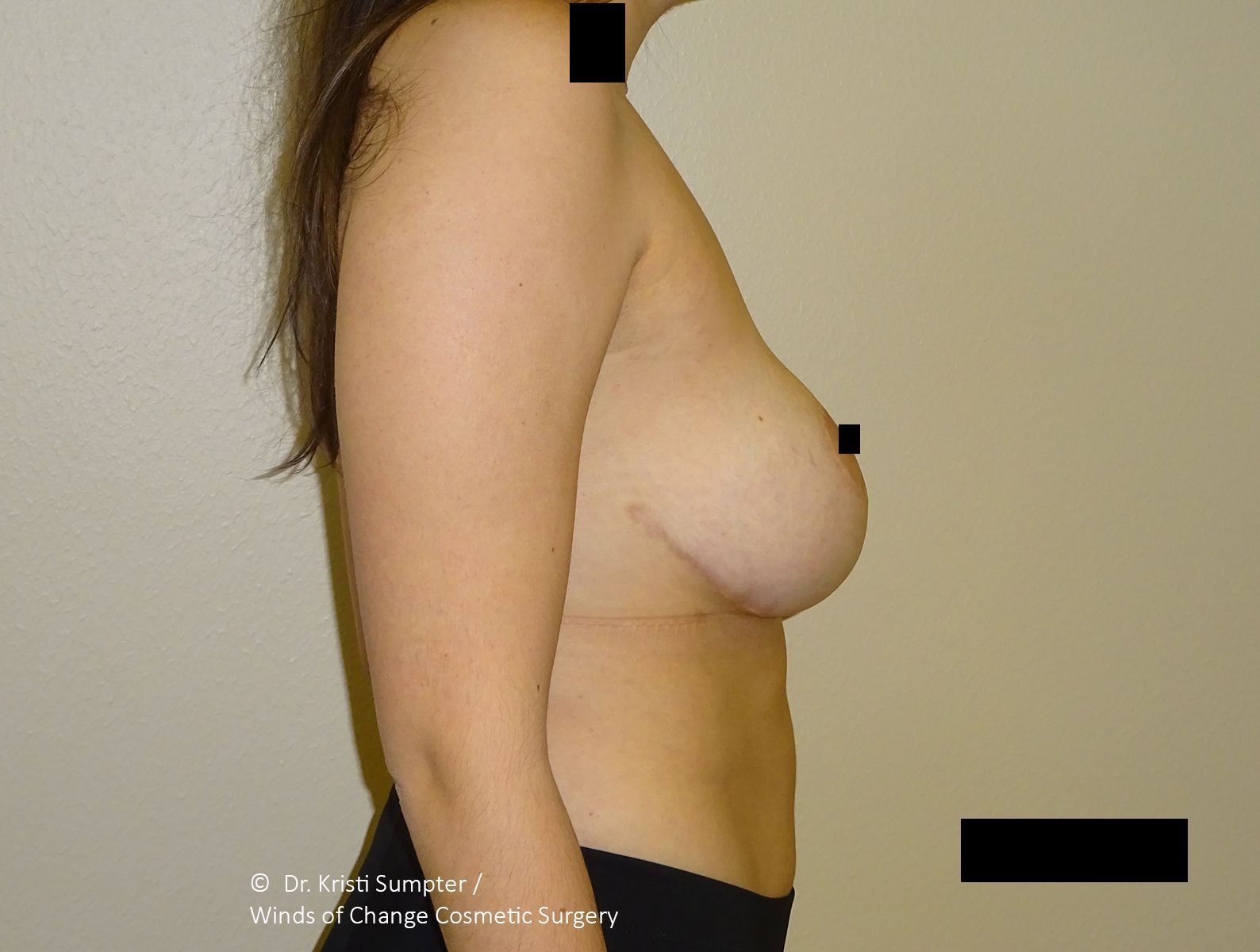 Woman's side profile, torso visible, in front of a plain wall. Breast tissue is visible, areas are obscured.