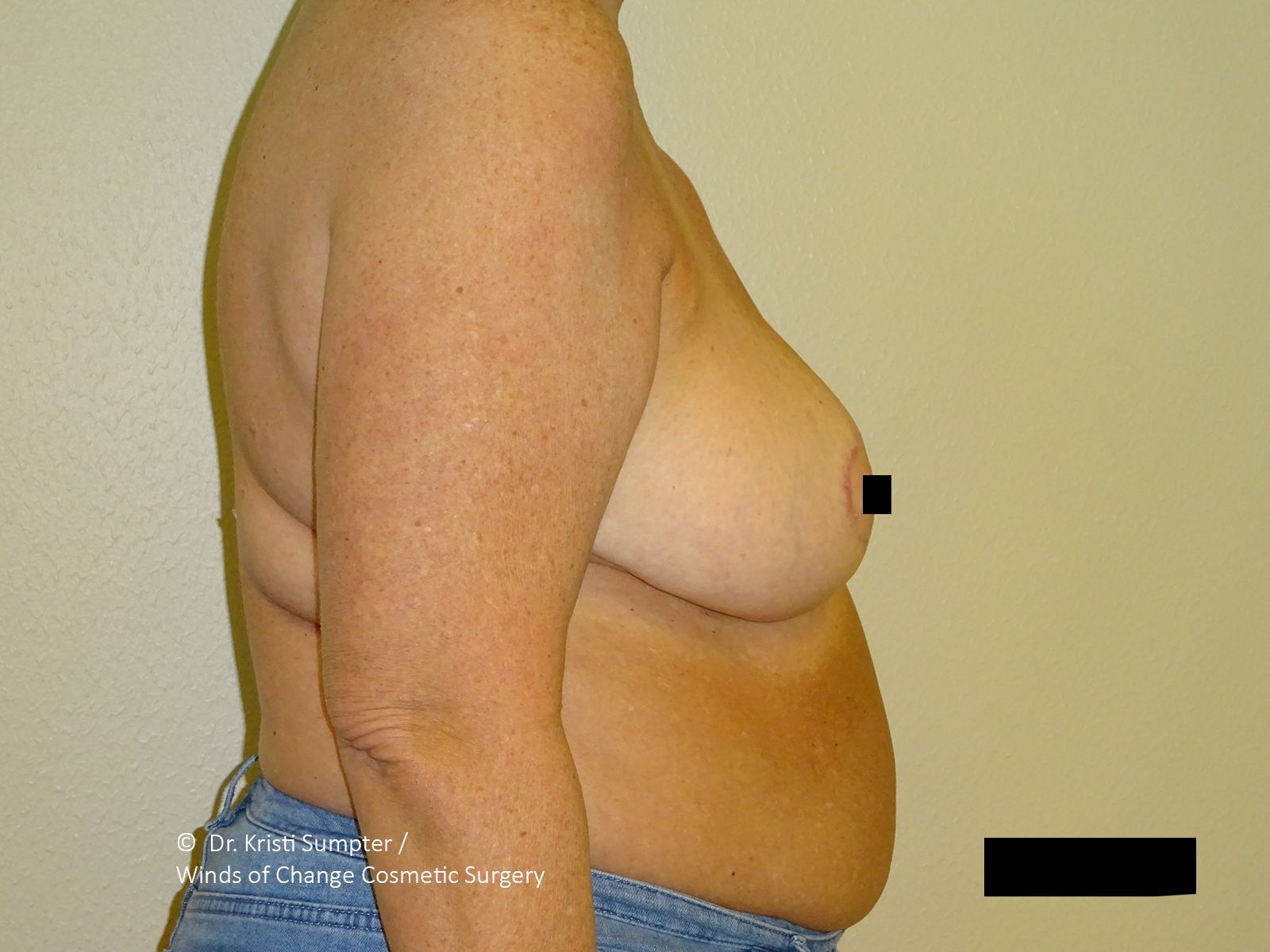 Side view of a person's torso and upper arm, with a bare chest and midsection.