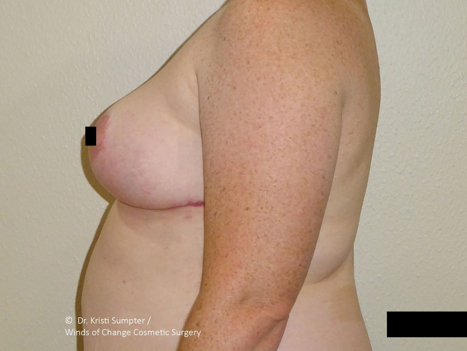 Side profile of a person's torso and arm with a breast and a scar from surgery.