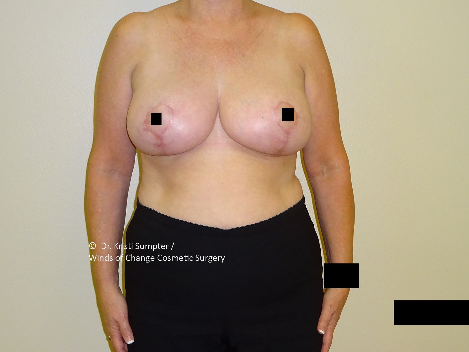 Woman's torso, breasts visible, scars present, wearing dark pants. Background is a plain wall.