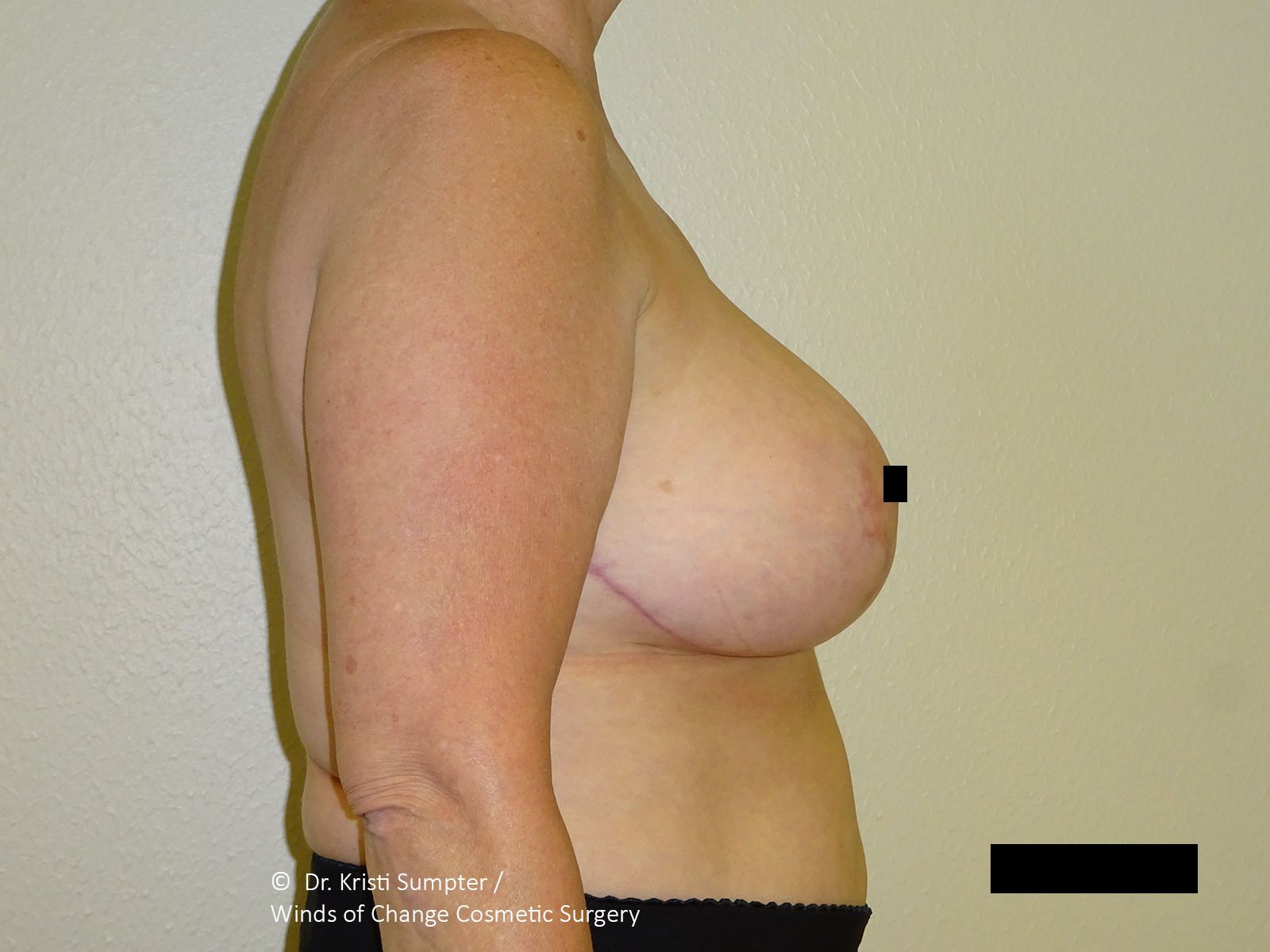 Side view of a person's torso, showing breast and arm. Skin is pale, set against a plain background.