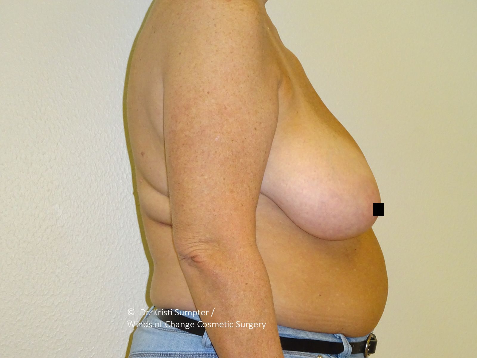 Woman's torso and arm, side view, in front of a plain wall. Breasts are visible. She is wearing blue jeans.