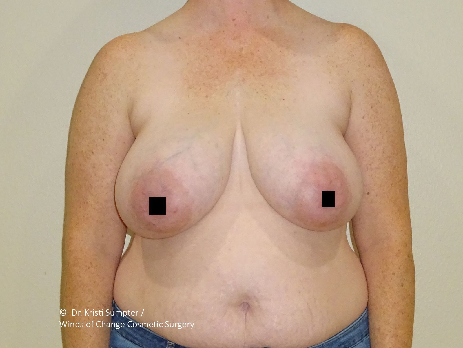 Torso of a person, breasts and stomach visible, some freckles.