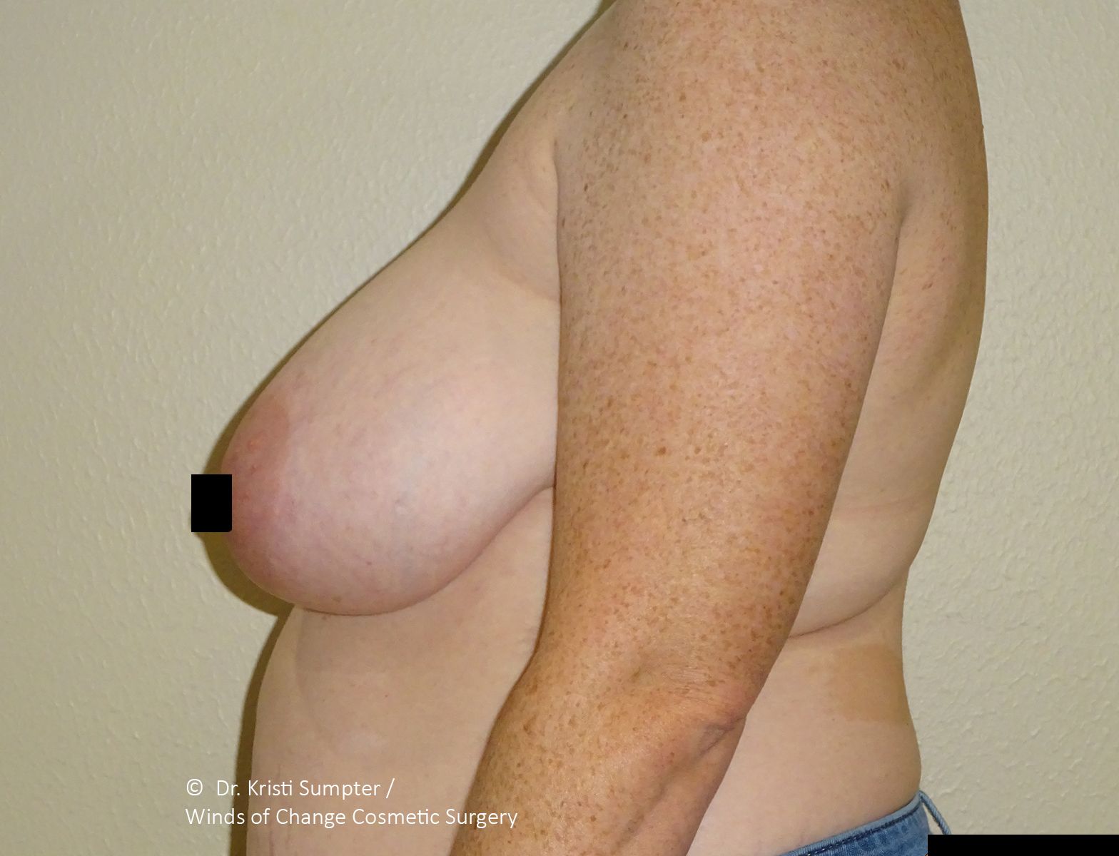 Side view of a torso. Breast is prominent and visible with a pixelated nipple. Arm is bent, and skin tone is light.