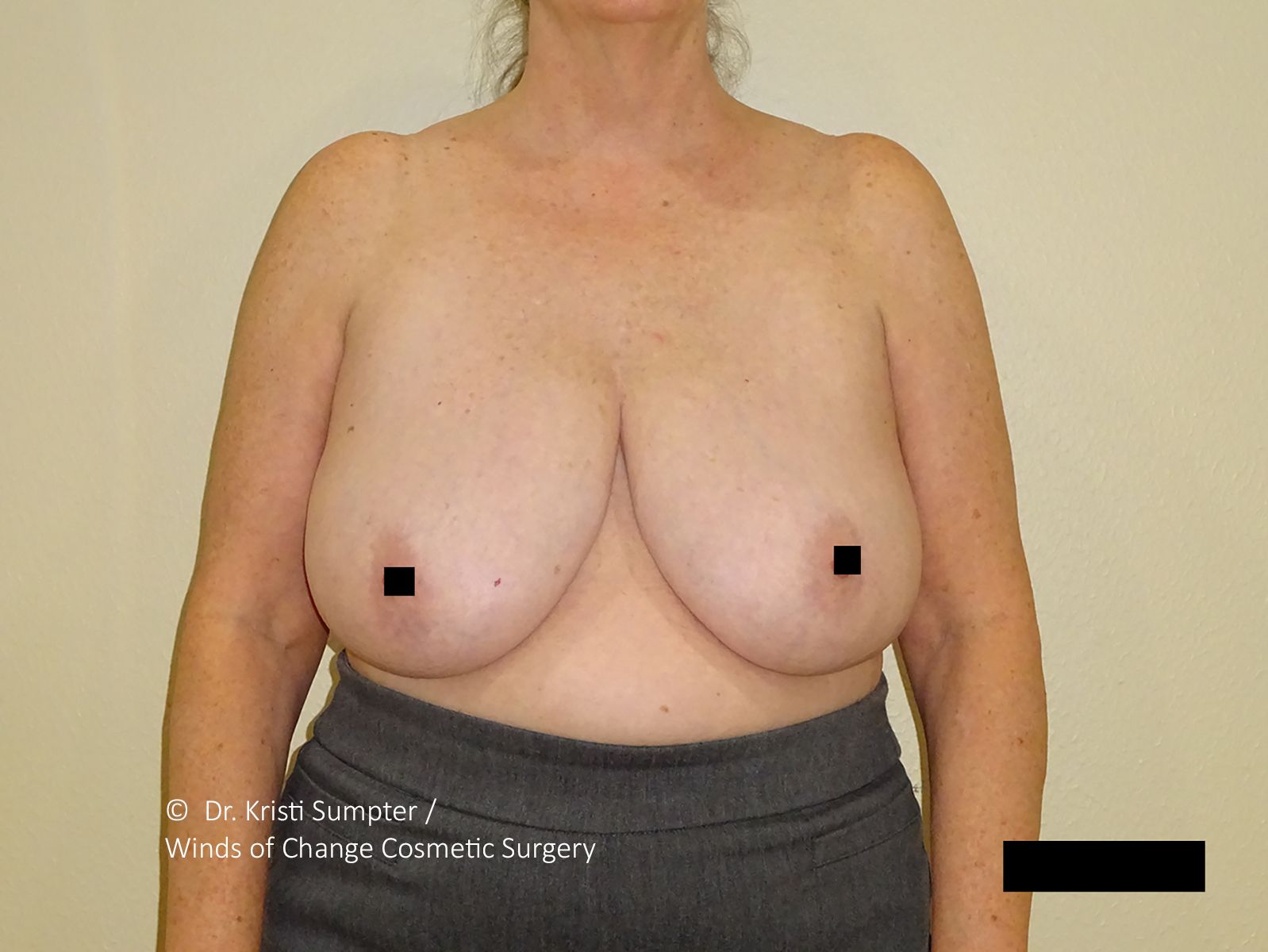 Woman's bare chest, facing forward, breasts slightly asymmetrical, wearing dark skirt, neutral background.