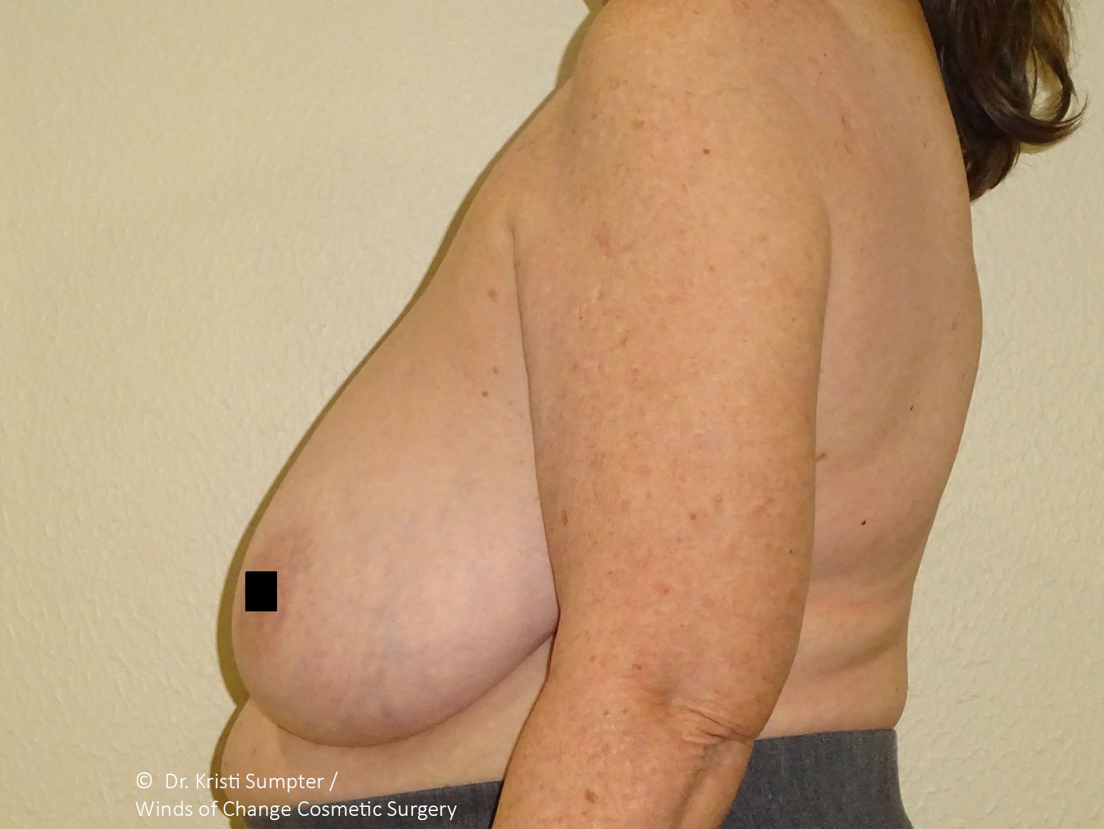 Side view of a person with a large breast. Dark square covers a portion. Light background.