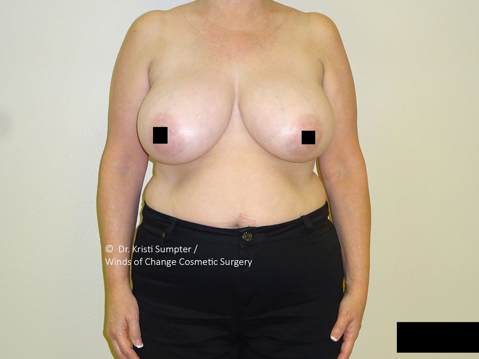 A person stands facing forward, bare-chested with black pants. Breast skin is smooth. Nipples are obscured by black squares.