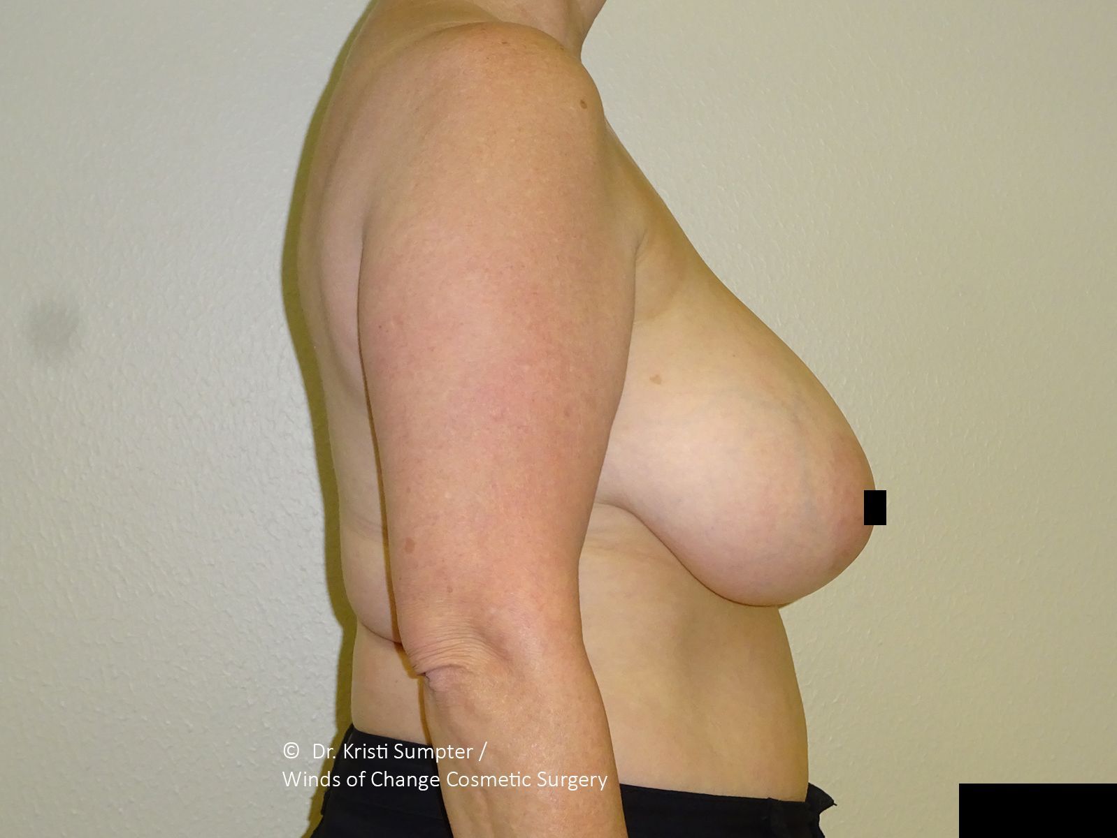 Side view of a person's torso and arm; breasts are visible.