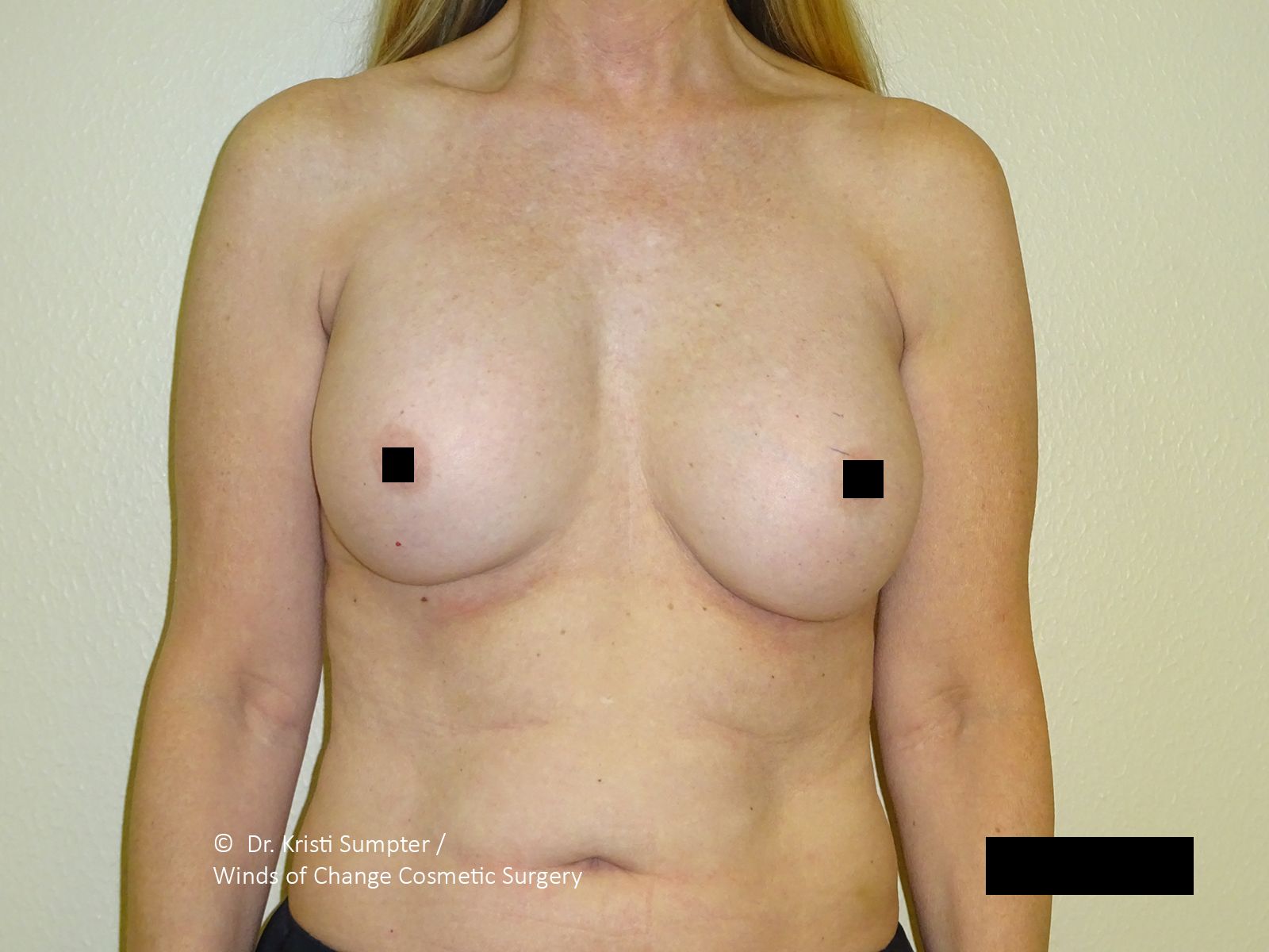 Before front breast explant with fat transfer