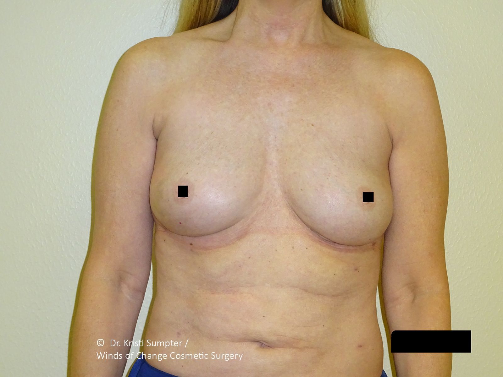 After front breast explant with fat transfer