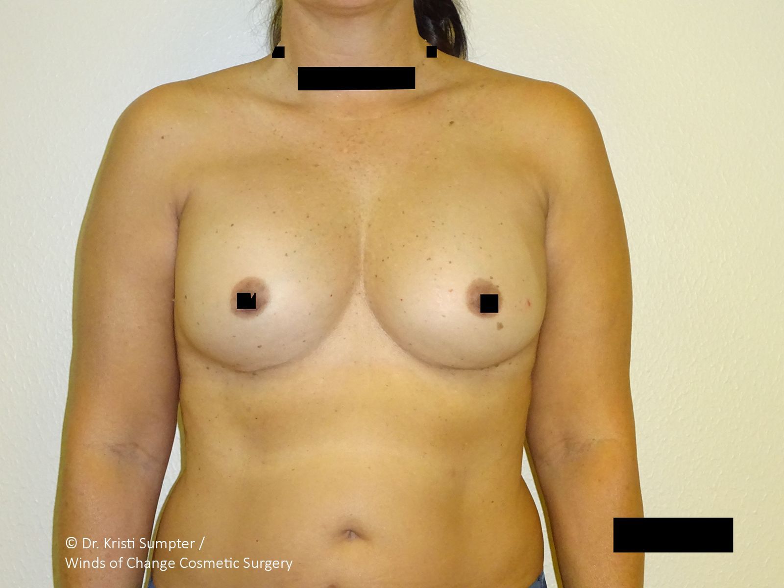 Before front breast explant