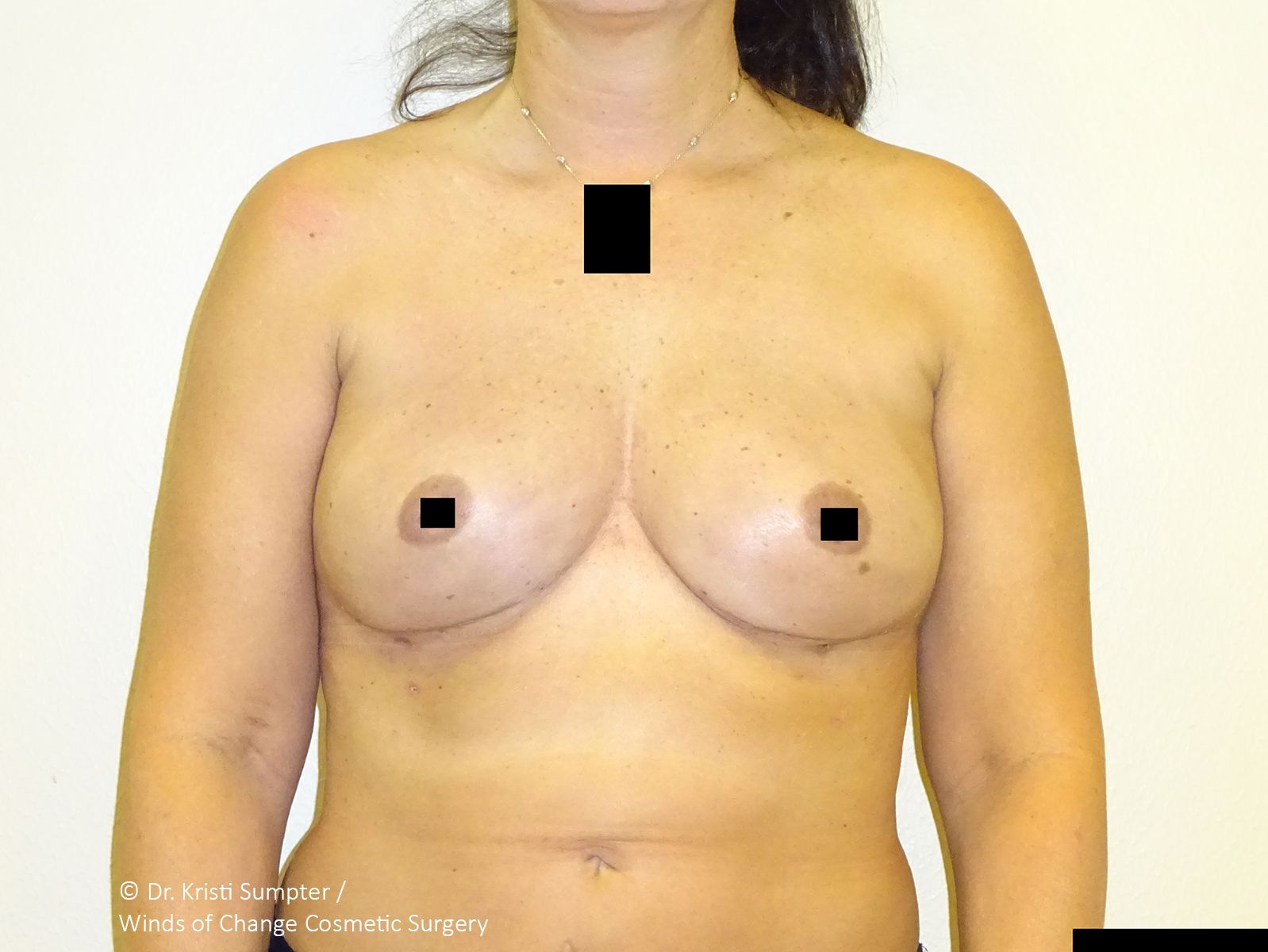 After front breast explant