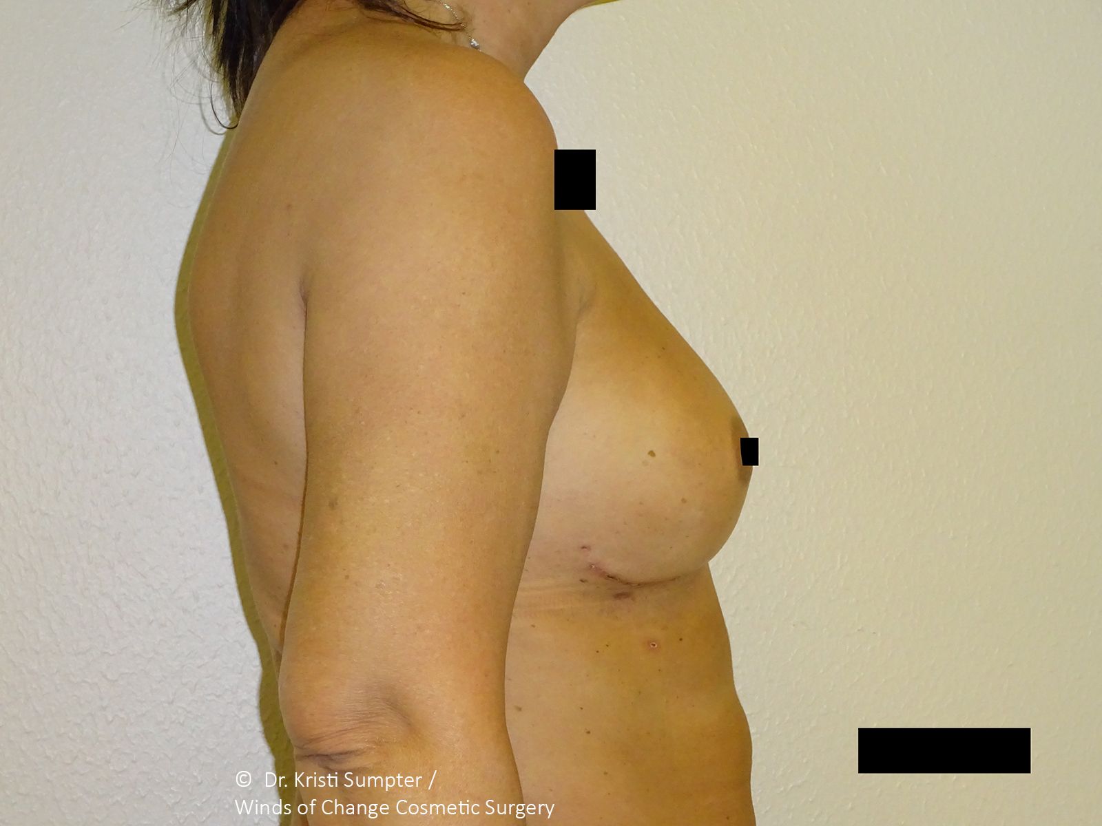 After side breast explant