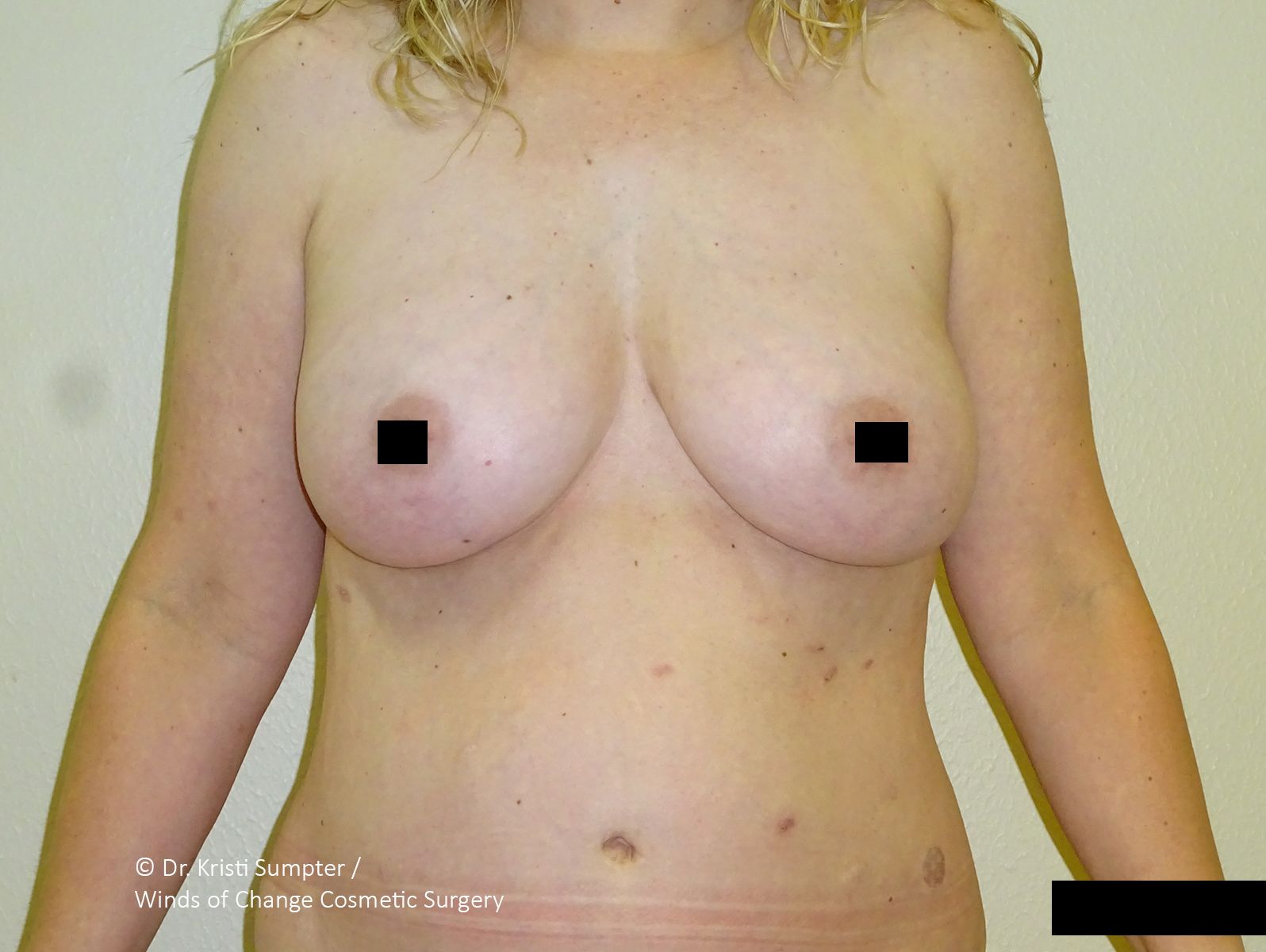Before breast explant front