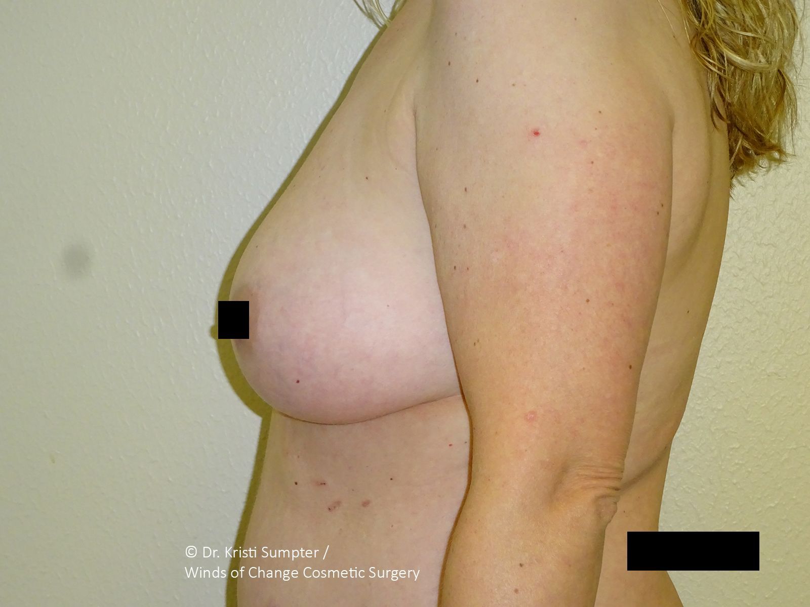 Before breast explant side