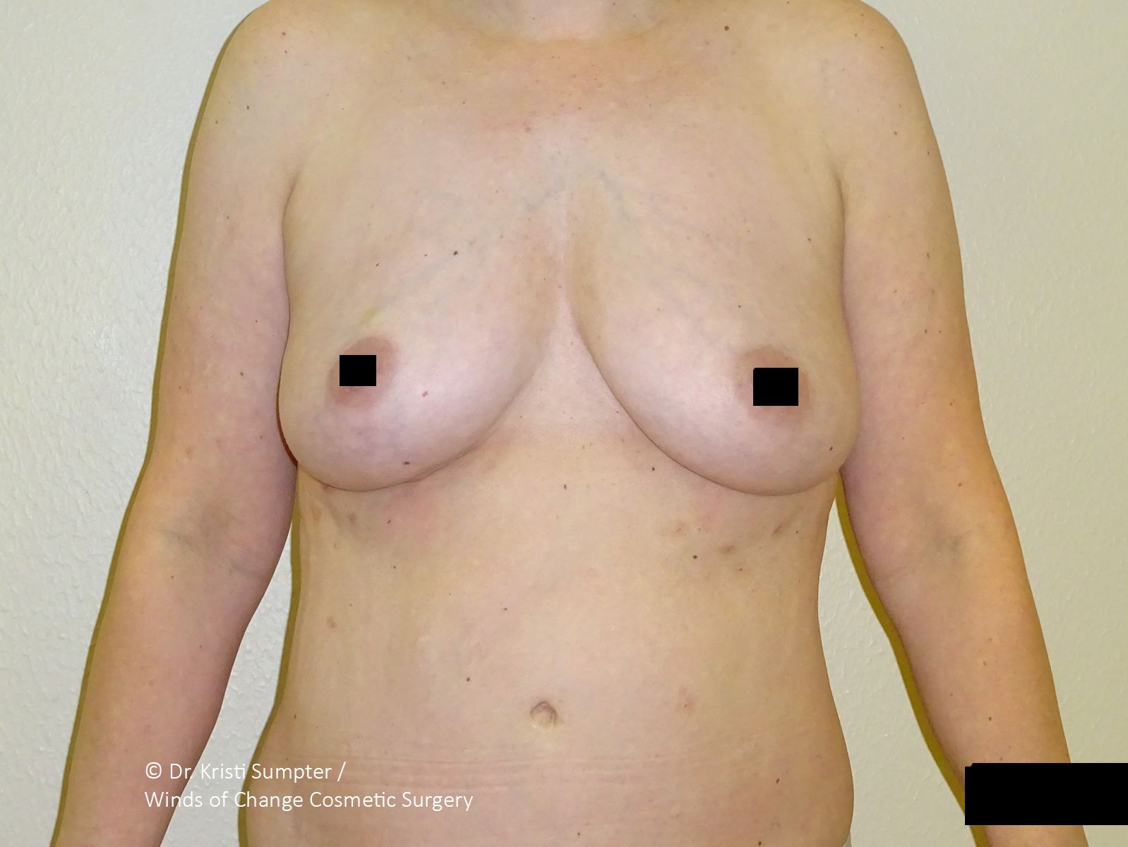 After breast explant front