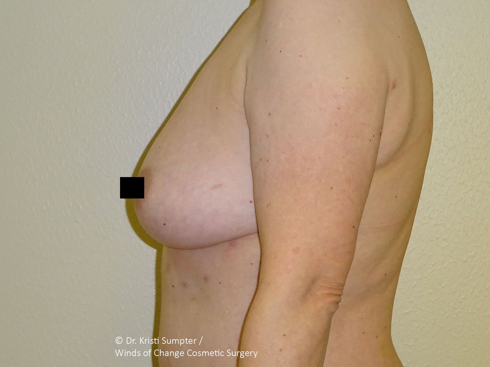 After breast explant side