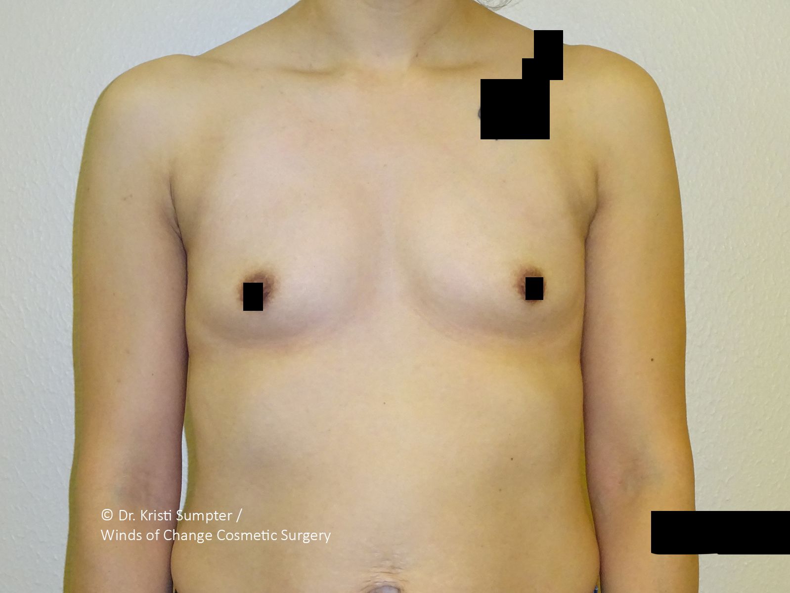 Torso of a person with small breasts, skin-tone, frontal view. Some areas blacked out.
