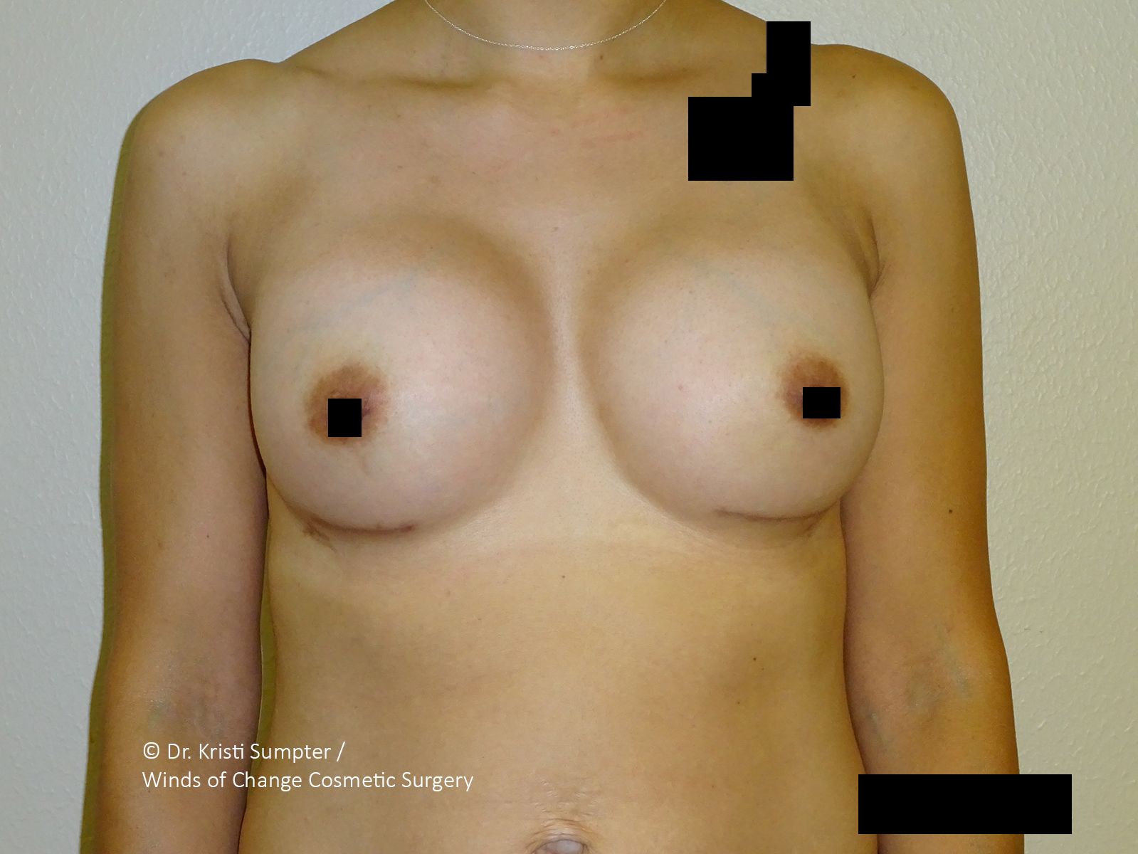 Torso of a person with breasts, some areas blacked out.