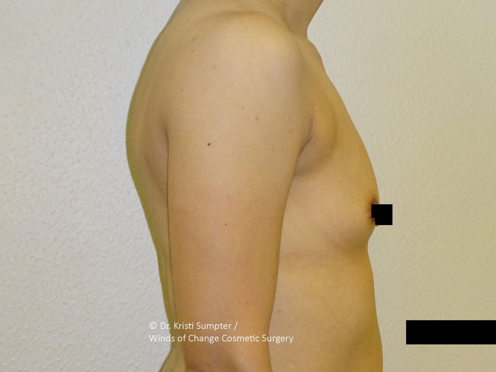 Side view of a torso with nipple obscured by a black rectangle.