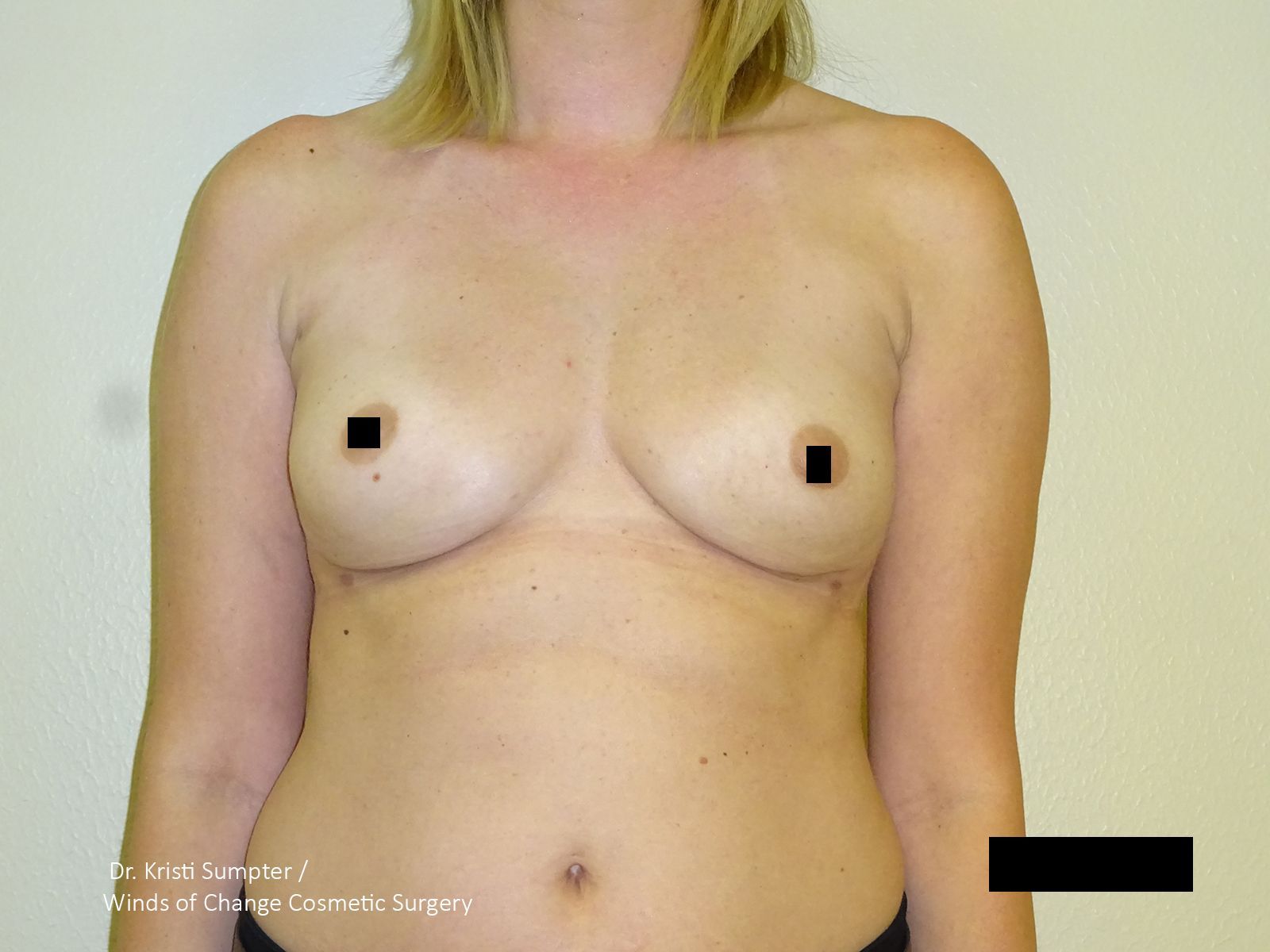 Before side breast explant with fat transfer