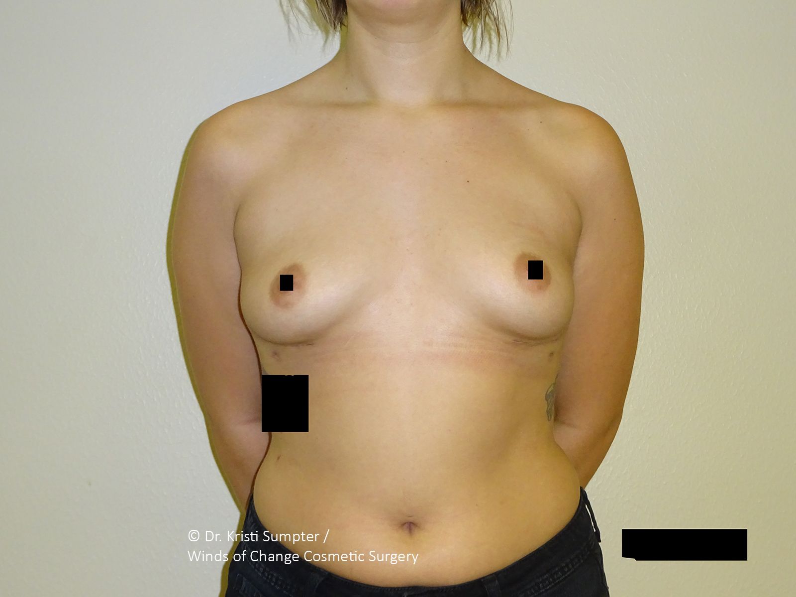 Before side breast explant with fat transfer