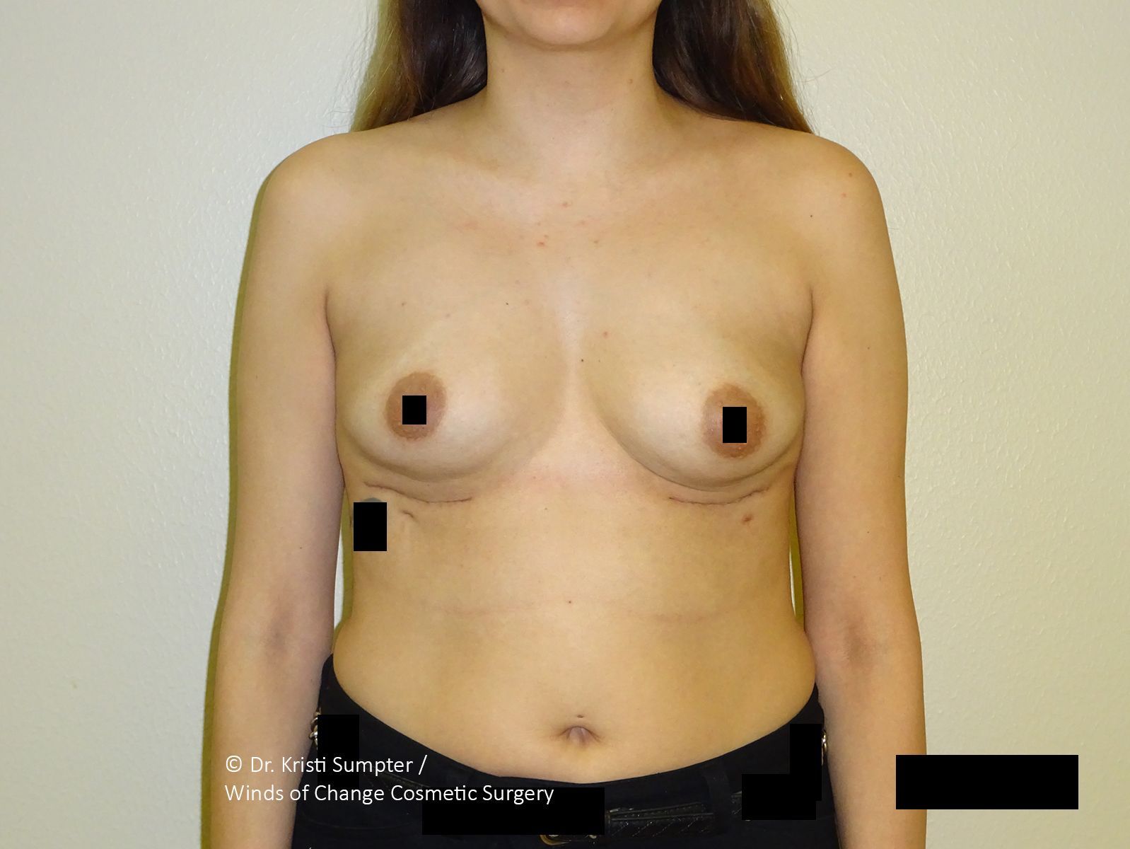 Before side breast explant with fat transfer