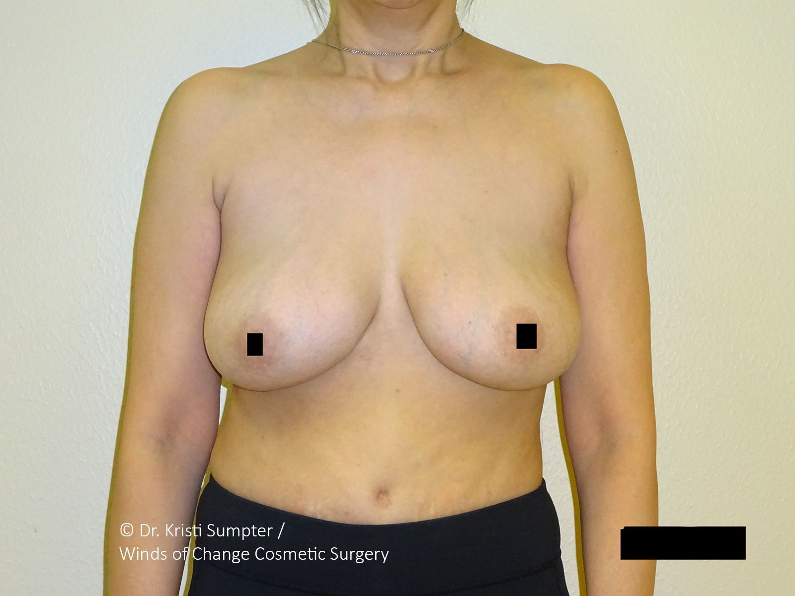 Before side breast explant with fat transfer