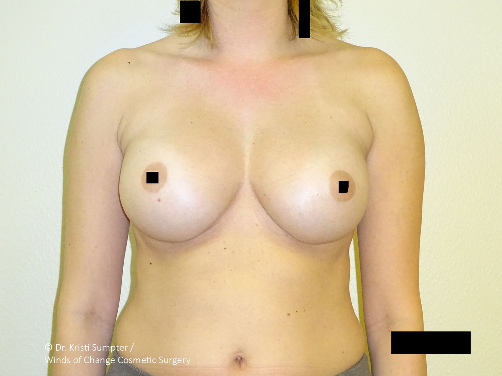Before front breast explant with fat transfer