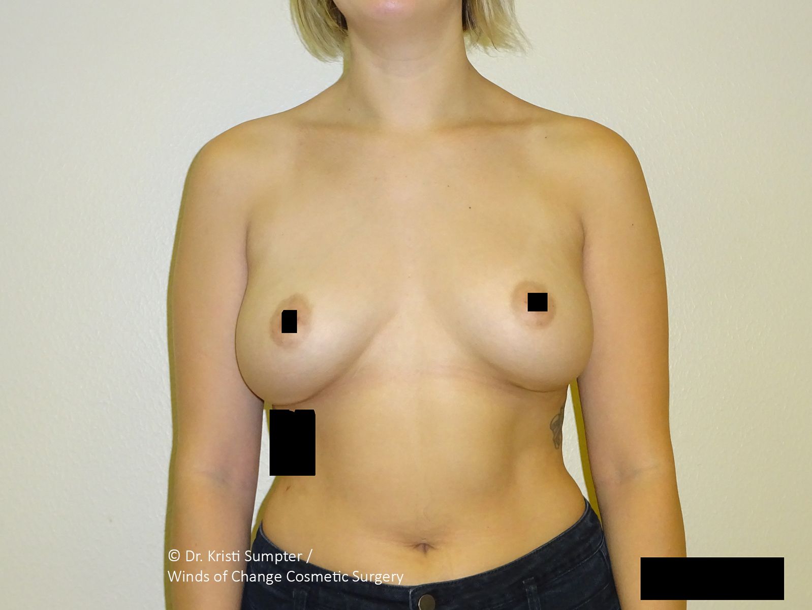 Before front breast explant with fat transfer