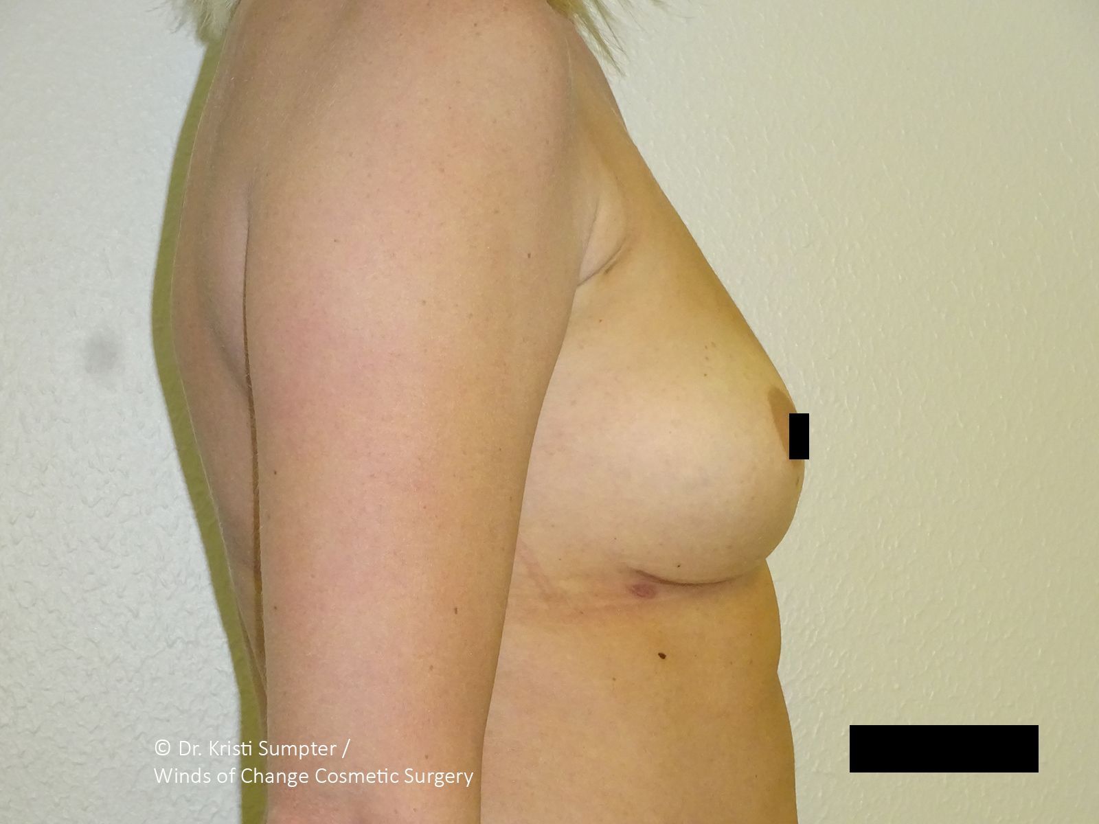 After front breast explant with fat transfer