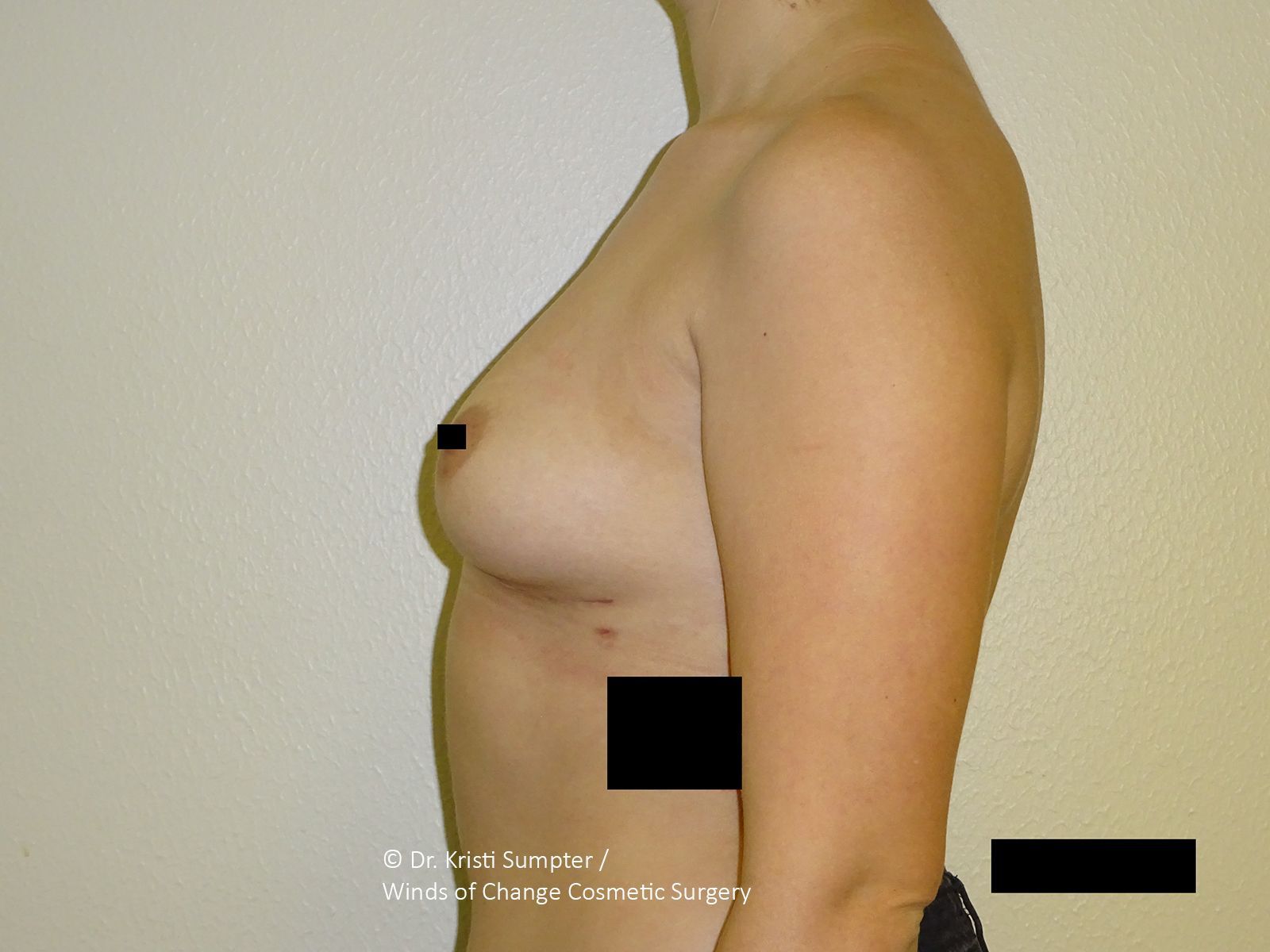 After front breast explant with fat transfer