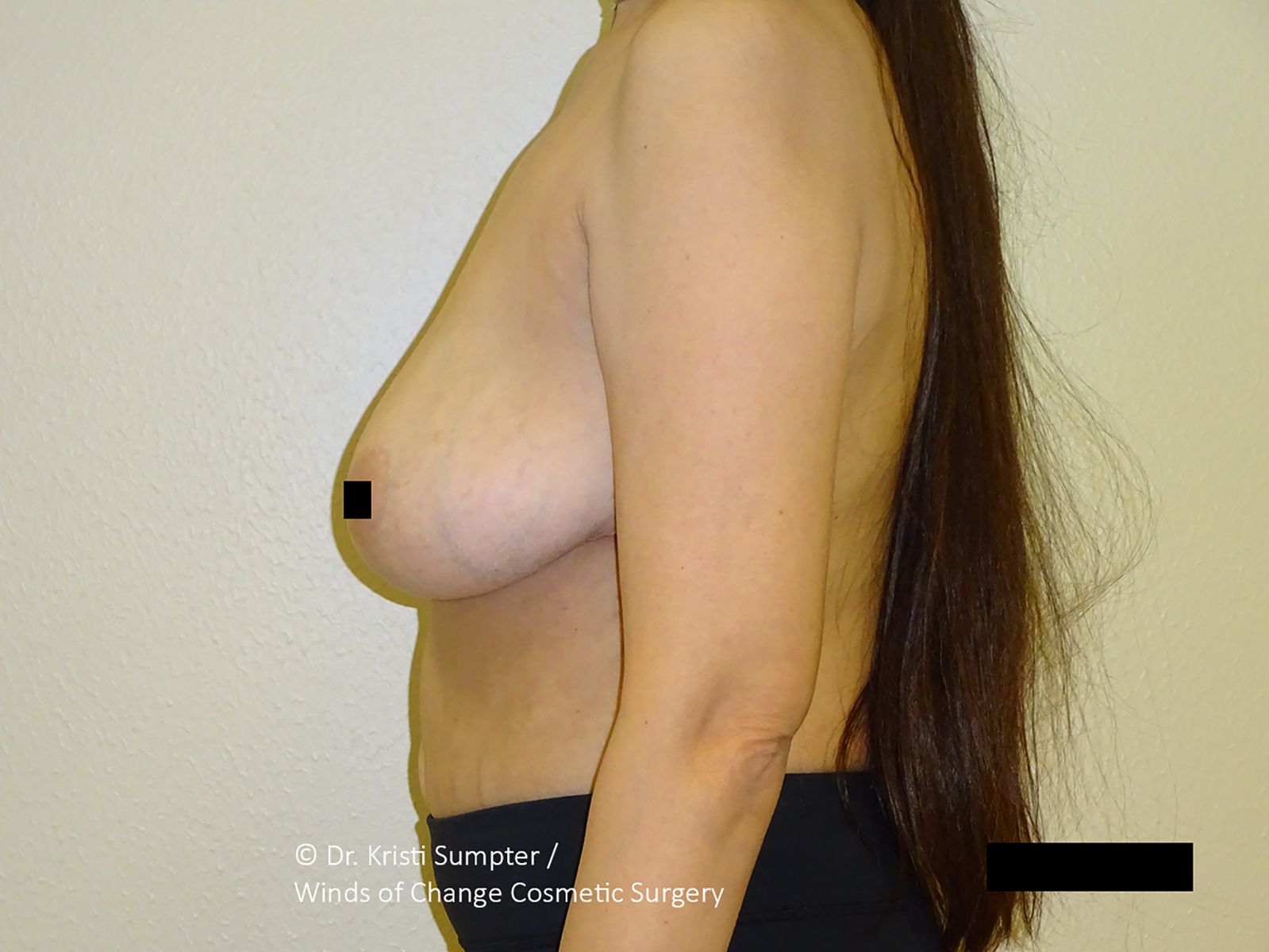 After front breast explant with fat transfer