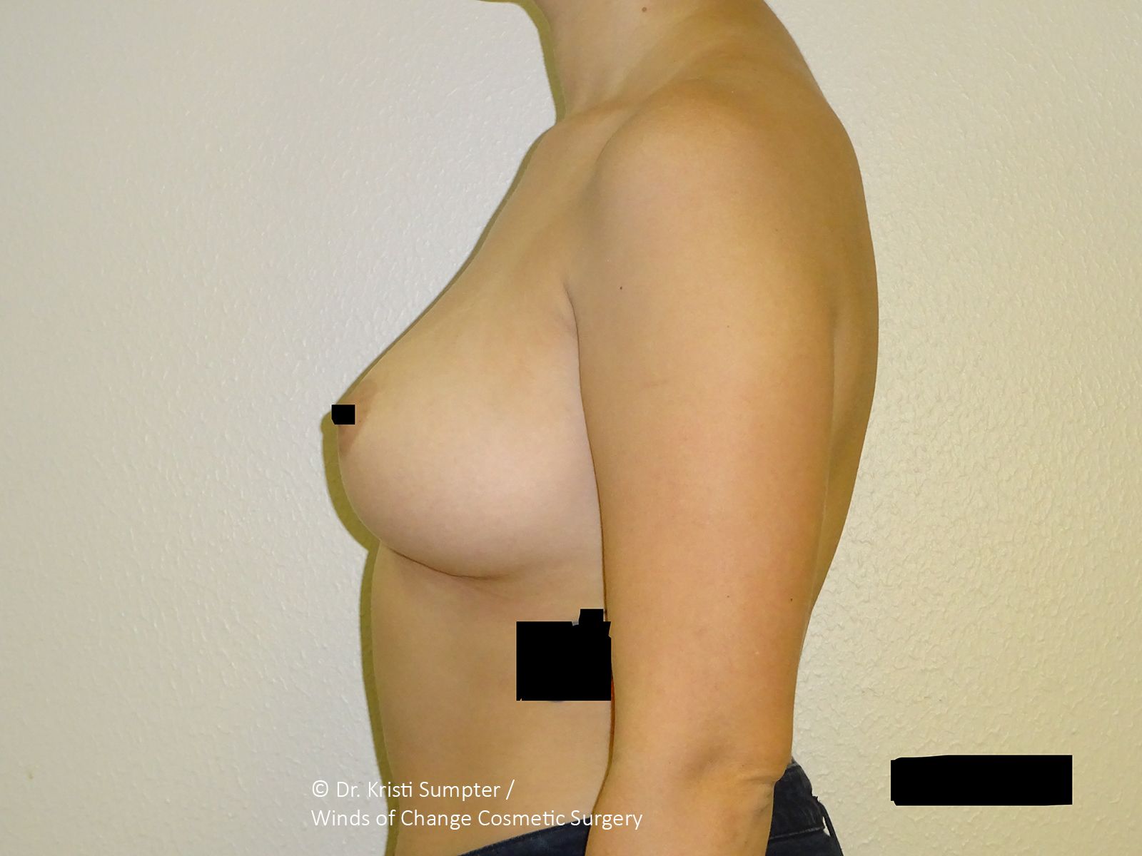 After front breast explant with fat transfer