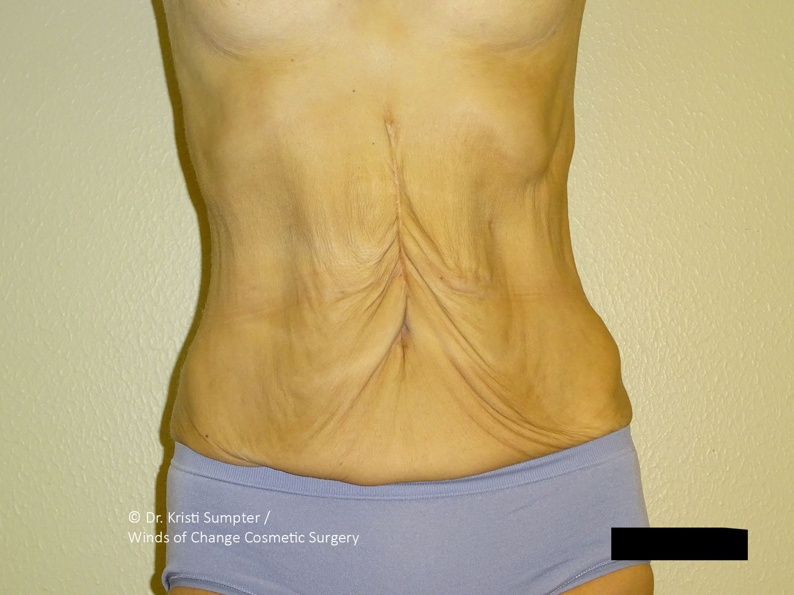 Midsection with loose, wrinkled abdominal skin, likely showing pre surgical skin laxity. 