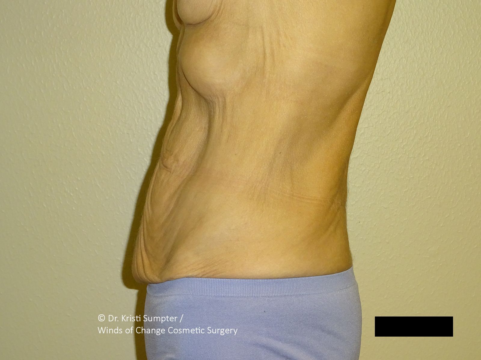 Side view of a person wearing a bra and bikini bottoms, with visible skin folds and some discoloration. 