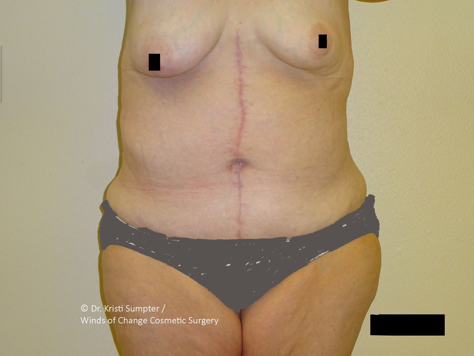 Midsection of a person showing a vertical surgical scar extending from the chest area down to the abdomen.