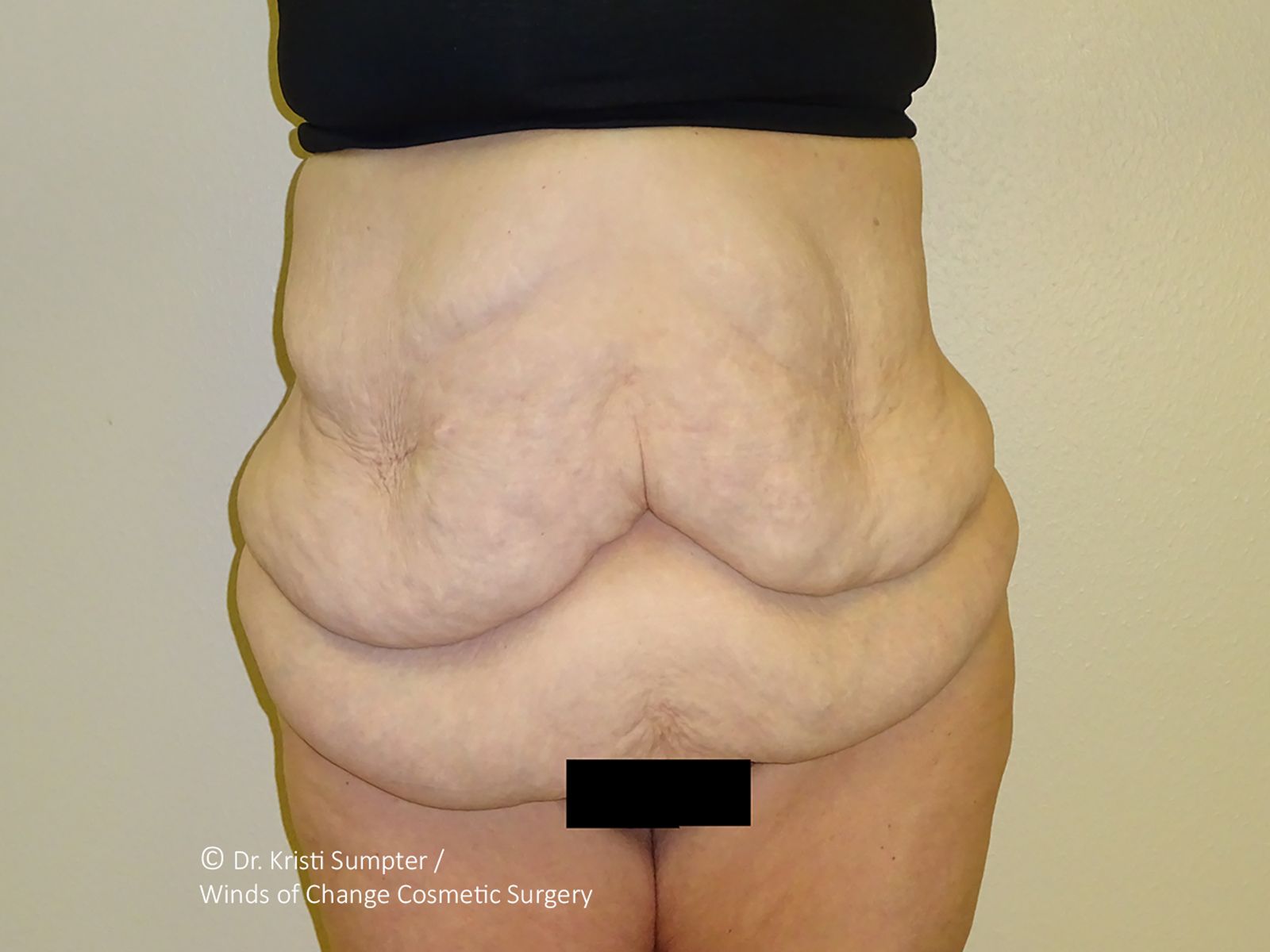 Midsection with loose, wrinkled abdominal skin, likely showing pre surgical skin laxity. 