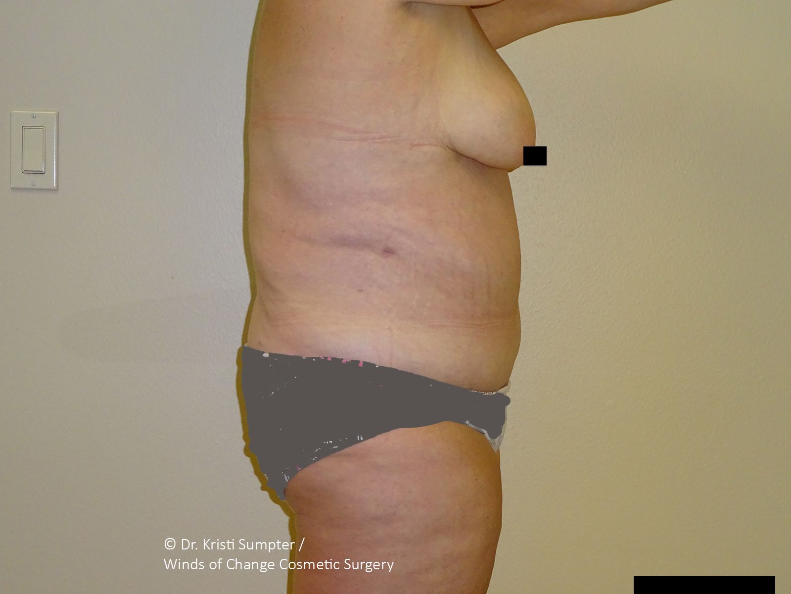 Side profile of a torso showing skin laxity and body contours, marked for medical evaluation. 