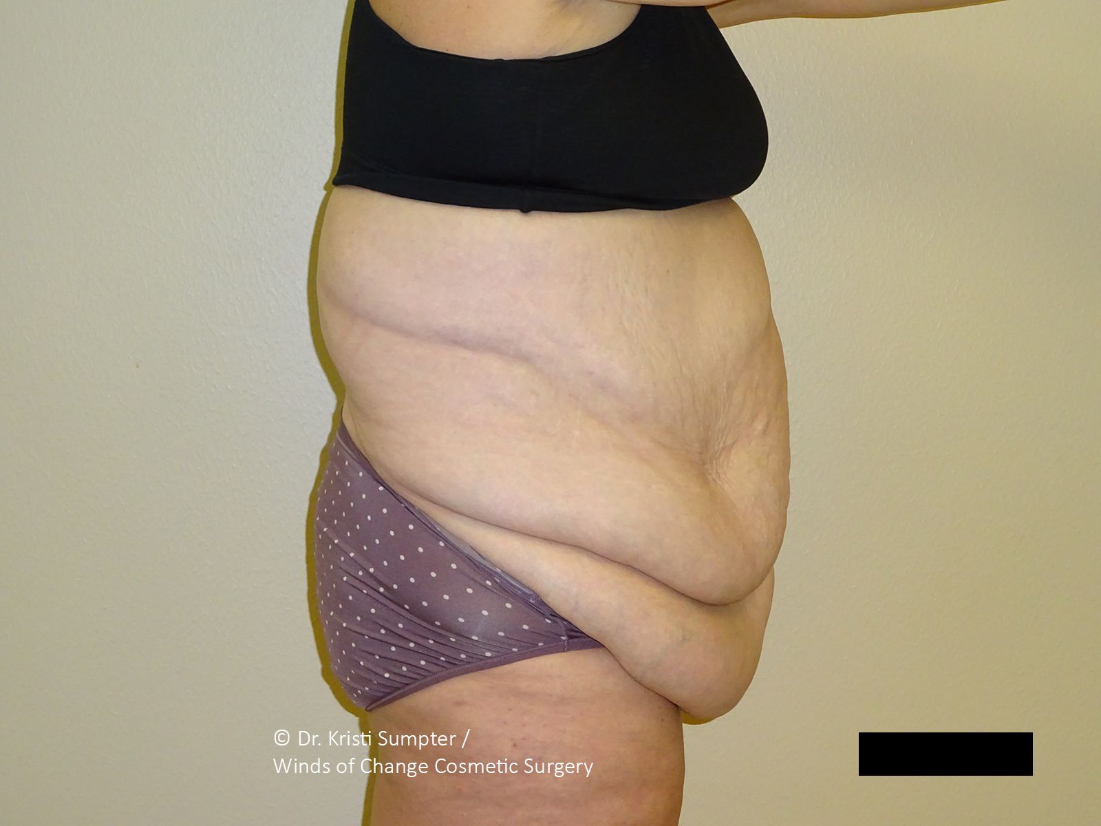 A profile view of an individual's abdomen showing significant loose skin, typical of a pre surgery medical consultation. 