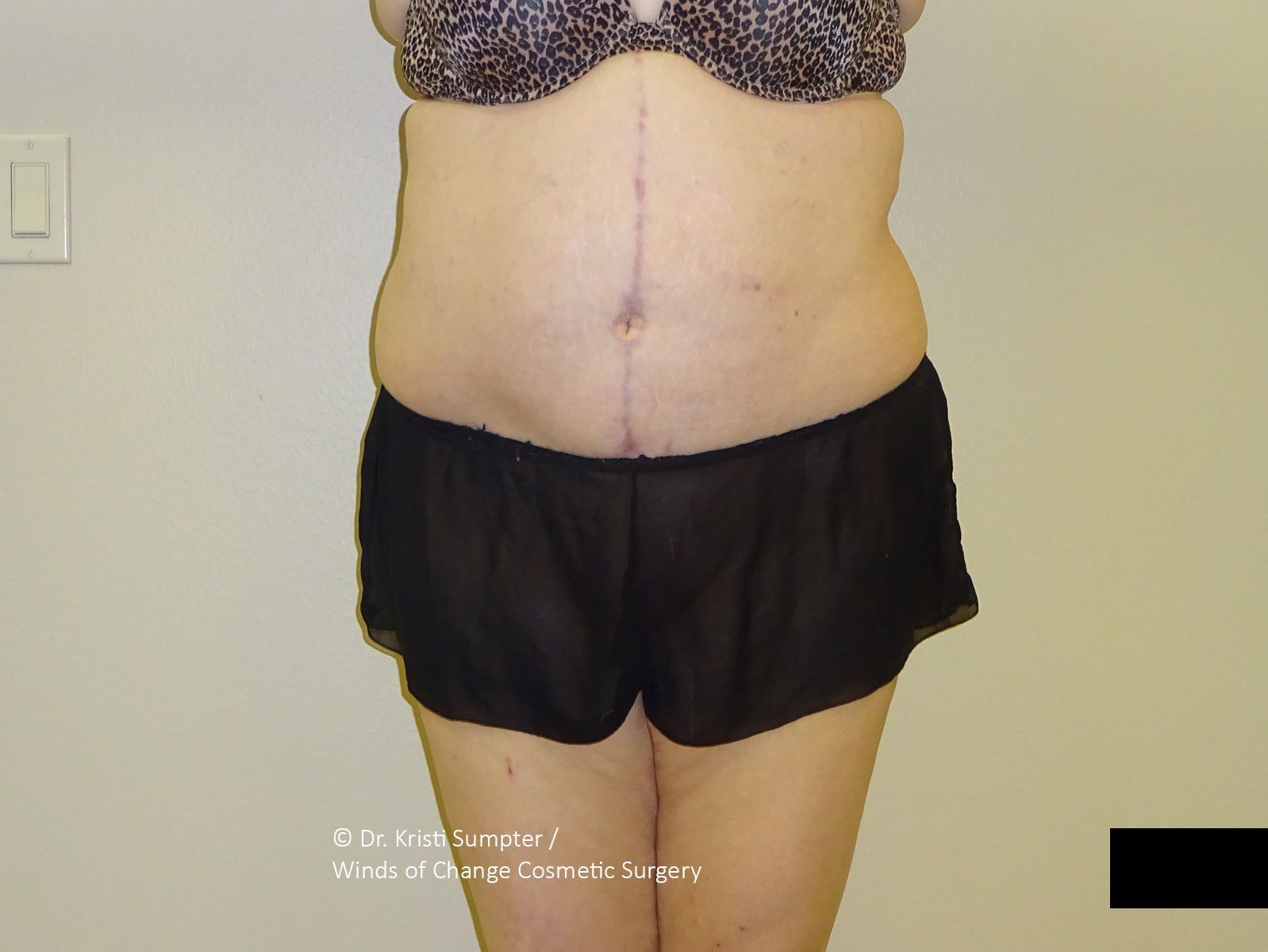 Torso of a person wearing black shorts, showing a vertical surgical scar on the abdomen. 