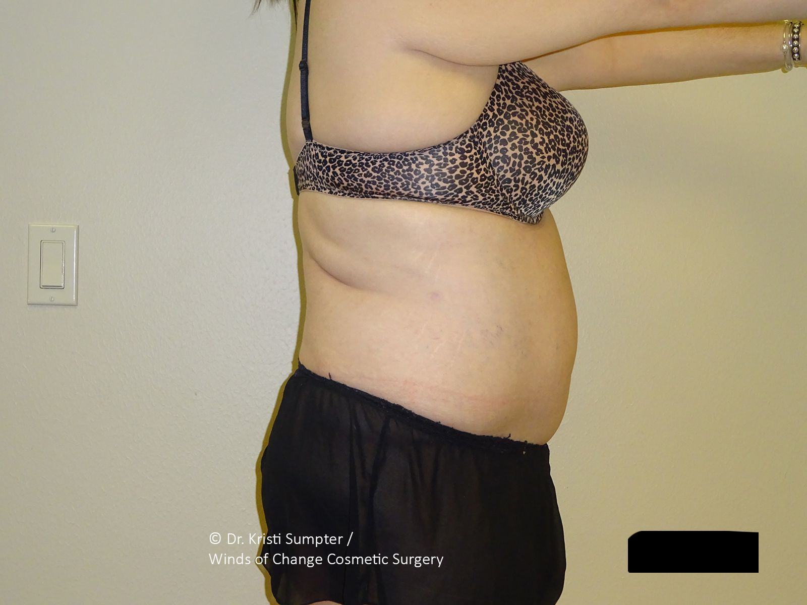 Side profile of a person’s torso showing midsection skin laxity and body contours, standing against a neutral wall. 