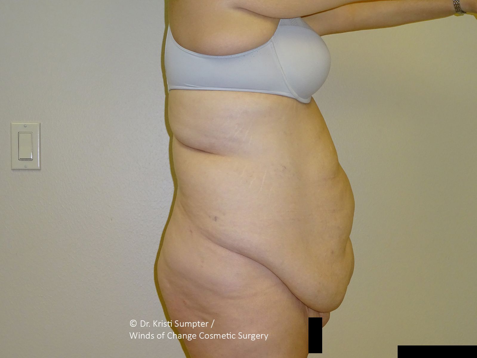Side profile view of a person’s abdomen showing significant skin laxity and tissue accumulation. 