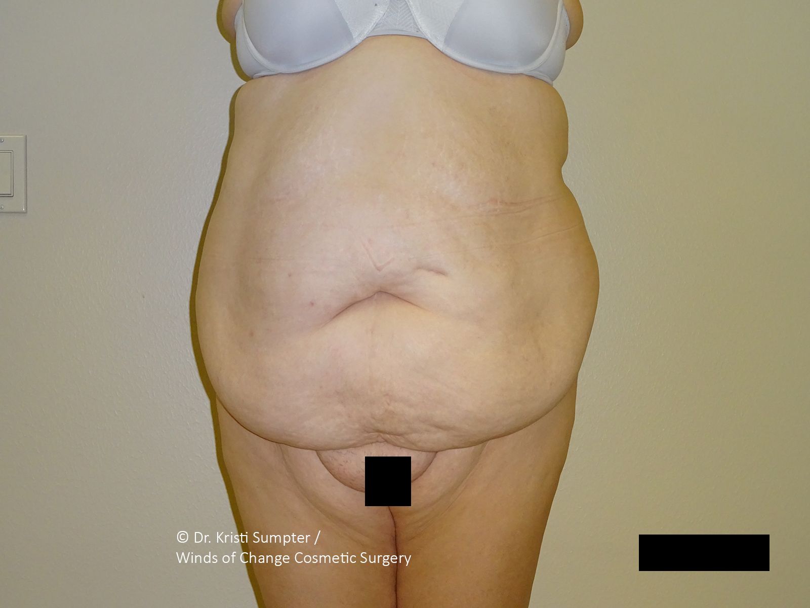 Front view of an abdomen with significant skin laxity and an overhanging abdominal fold. 