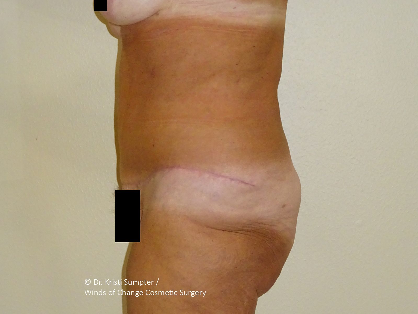 Side profile view of a torso showing a post-surgical scar across the lower abdomen following a tummy tuck procedure. 