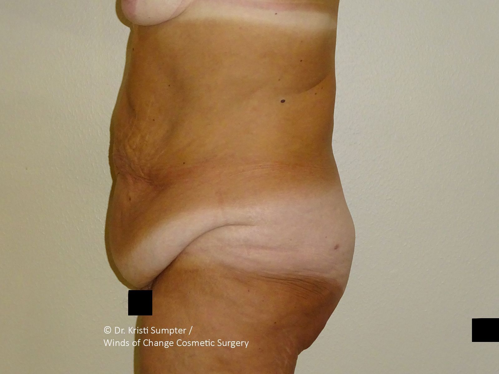 Profile view of an abdomen with excess skin laxity and a faint horizontal surgical scar near the lower pelvic area. 